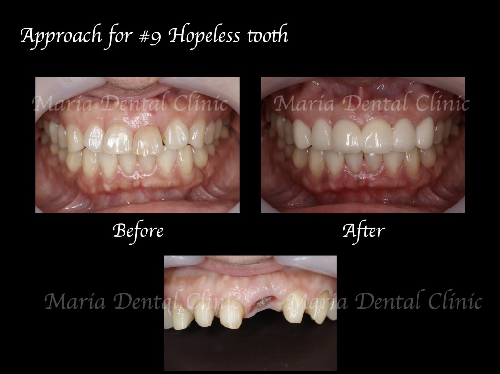 目白マリア歯科【症例】前歯の歯牙保存が不可能なケース①_Before:After