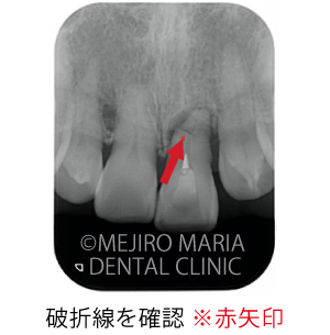 目白マリア歯科【症例】前歯の歯牙保存が不可能なケース①_治療前_破折線が確認できるレントゲン写真