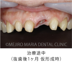 目白マリア歯科【症例】前歯の歯牙保存が不可能なケース①_治療後_治療途中