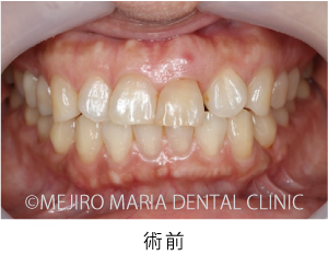 目白マリア歯科【症例】前歯の歯牙保存が不可能なケース①_治療後_術前の状態