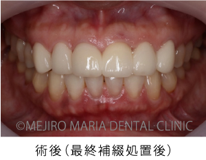 目白マリア歯科【症例】前歯の歯牙保存が不可能なケース①_治療後_術後の状態