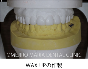 目白マリア歯科【症例】前歯の歯牙保存が不可能なケース①_治療詳細_WAX UPの作製
