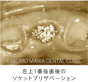 目白マリア歯科【症例】前歯の歯牙保存が不可能なケース①_治療詳細_ソケットブリザベーション