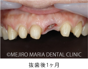 目白マリア歯科【症例】前歯の歯牙保存が不可能なケース①_治療詳細_抜歯後1ヶ月の状態