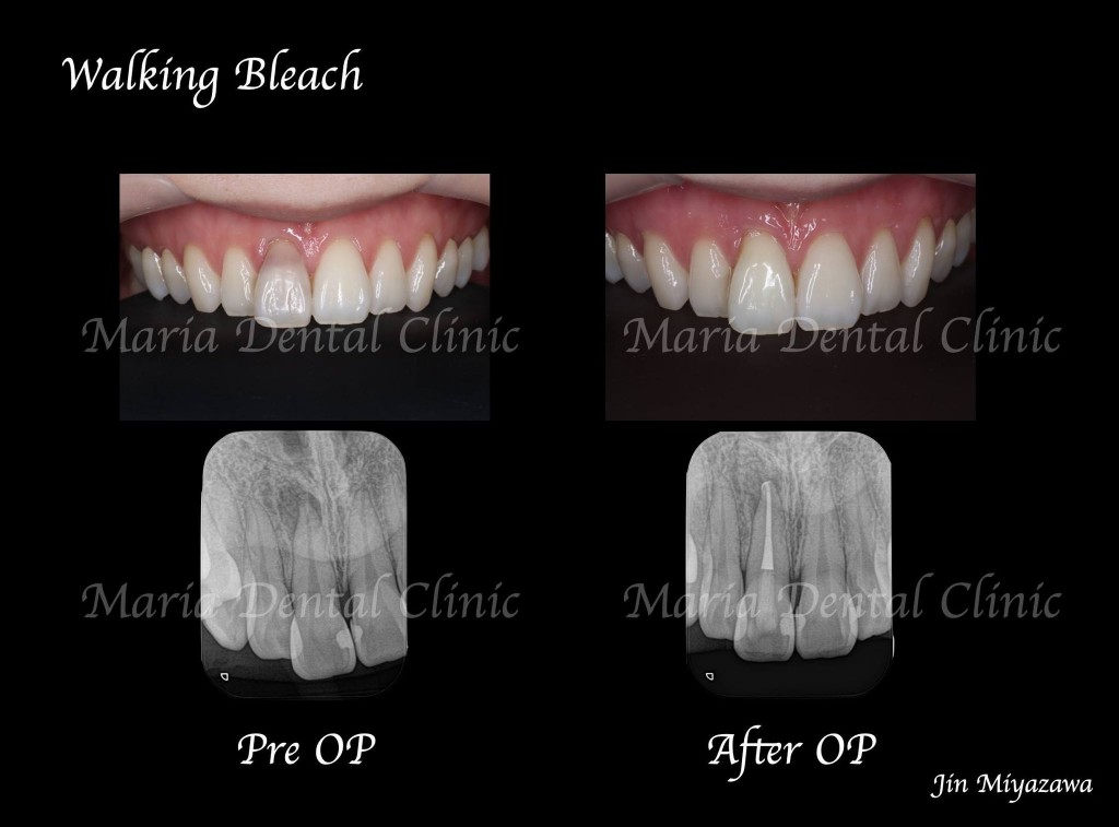 目白マリア歯科【症例】根管治療後のウォーキングブリーチによる審美的回復_Before:After