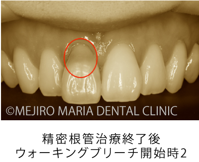 目白マリア歯科【症例】根管治療後のウォーキングブリーチによる審美的回復_治療前_精密根管治療終了後_ウォーキングブリーチ開始時2