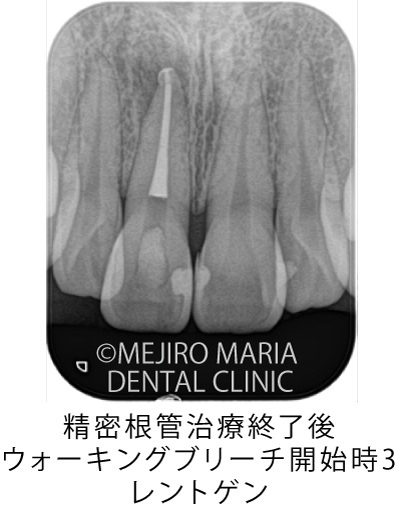 目白マリア歯科【症例】根管治療後のウォーキングブリーチによる審美的回復_治療前_精密根管治療終了後_ウォーキングブリーチ開始時3