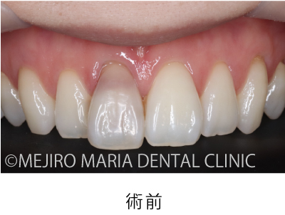 目白マリア歯科【症例】根管治療後のウォーキングブリーチによる審美的回復_治療後_術前の状態