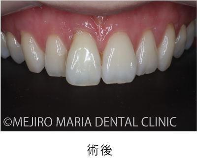 目白マリア歯科【症例】根管治療後のウォーキングブリーチによる審美的回復_治療後_術後の状態