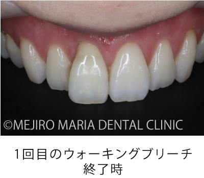 目白マリア歯科【症例】根管治療後のウォーキングブリーチによる審美的回復_治療詳細_1回目のウォーキングブリーチ終了時