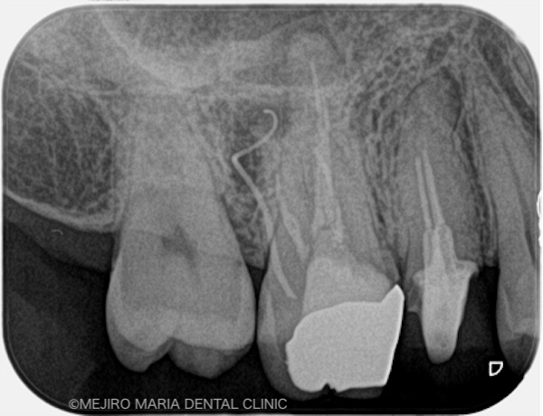 目白マリア歯科｜ブログ｜【症例】コンセプトを守った再根管治療（精密根管治療）｜治療前1