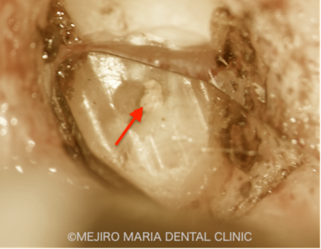 目白マリア歯科｜ブログ｜【症例】歯根端切除術の失敗をリカバリー（歯根端切除術）｜根尖切断面画像2_治療詳細2