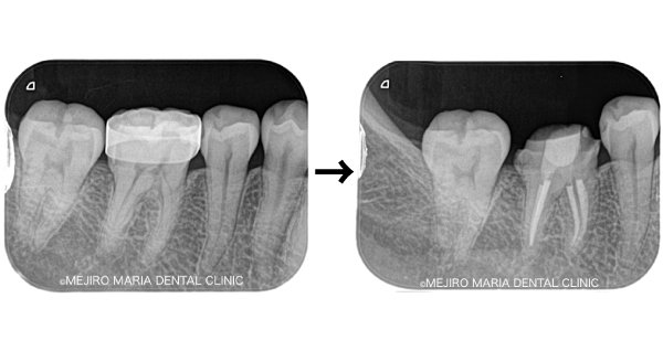【症例】「虫歯がないのに歯が痛い」確実な診査診断で原因不明の痛みを解決（クラックトゥース編）