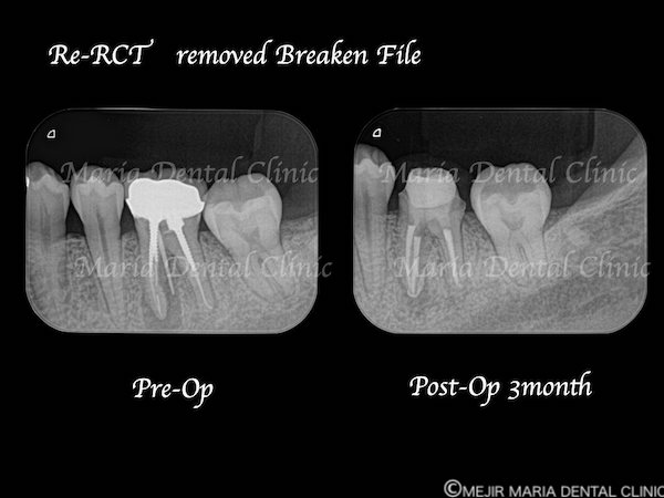 【症例】根管治療のトラブルケース:「破折ファイル」の対処法と考え方