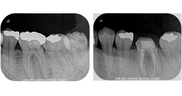 【症例】無症状で進行する虫歯・原因不明の歯肉の腫れを、コンセプトを守った初回根管治療（精密根管治療）で治癒 　