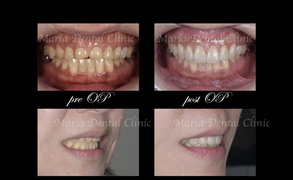 【症例】前歯の見た目を改善し自然なスマイルラインを獲得