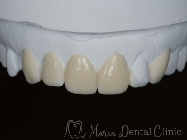 ワックスアップ|【症例】前歯の見た目を改善し自然なスマイルラインを獲得|目白マリア歯科