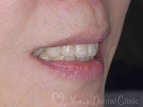 治療後の口元の写真|【症例】前歯の見た目を改善し自然なスマイルラインを獲得|目白マリア歯科