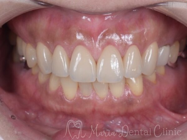 治療後の写真|【症例】前歯の見た目を改善し自然なスマイルラインを獲得|目白マリア歯科