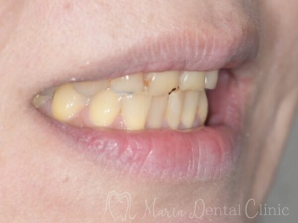 治療前の写真|【症例】前歯の見た目を改善し自然なスマイルラインを獲得|目白マリア歯科