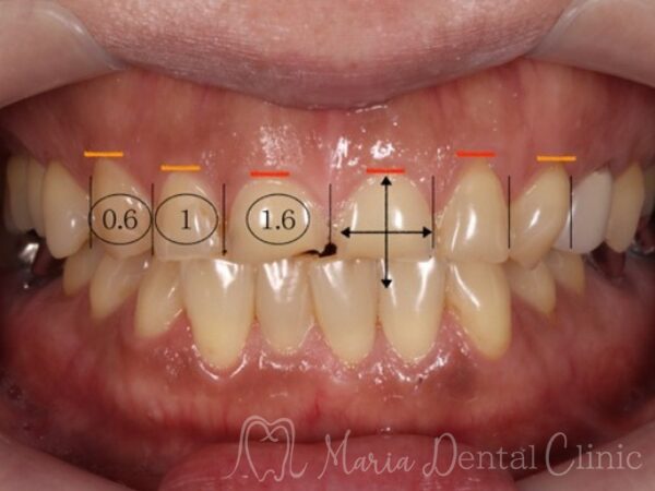説明用写真|【症例】前歯の見た目を改善し自然なスマイルラインを獲得|目白マリア歯科