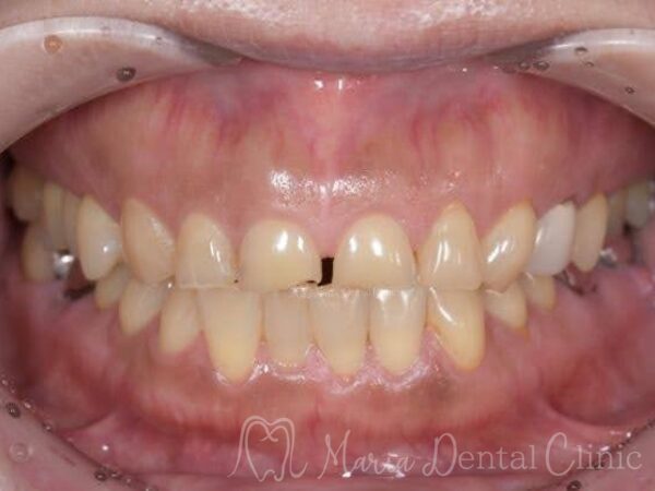 治療前の写真|【症例】前歯の見た目を改善し自然なスマイルラインを獲得|目白マリア歯科