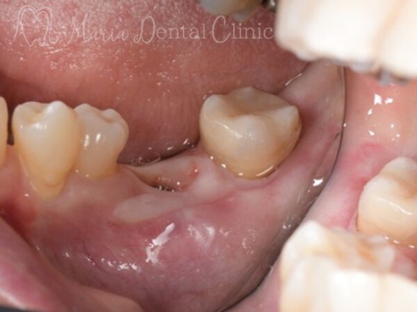 インプラント埋入３ヶ月後｜【症例】抜歯後に大きく失った骨をGBR（骨造成）で再建し、清掃性と長期安定性を確保したインプラント治療｜目白マリア歯科