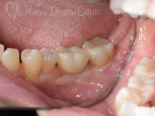 最終補綴装着時｜【症例】抜歯後に大きく失った骨をGBR（骨造成）で再建し、清掃性と長期安定性を確保したインプラント治療｜目白マリア歯科