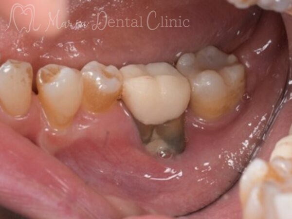術前｜【症例】抜歯後に大きく失った骨をGBR（骨造成）で再建し、清掃性と長期安定性を確保したインプラント治療｜目白マリア歯科
