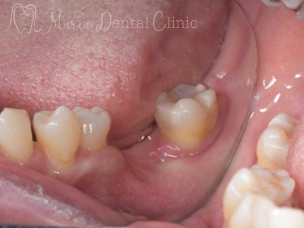 抜歯後４ヶ月｜【症例】抜歯後に大きく失った骨をGBR（骨造成）で再建し、清掃性と長期安定性を確保したインプラント治療｜目白マリア歯科