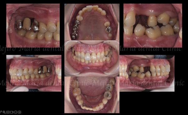 治療前の画像1|【症例】サイナスリフトで骨を増やし奥歯の支えを回復したインプラント治療|目白マリア歯科