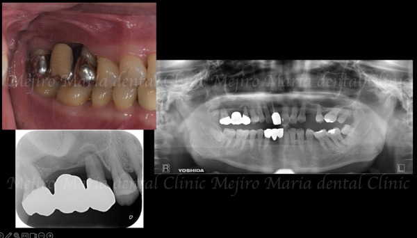 治療前の画像2|【症例】サイナスリフトで骨を増やし奥歯の支えを回復したインプラント治療|目白マリア歯科