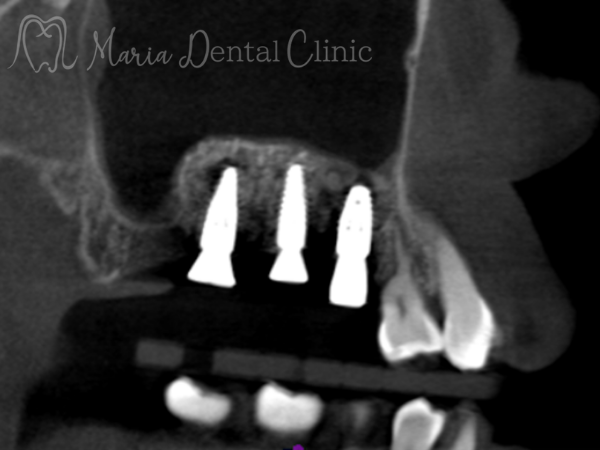 治療後の画像|【症例】サイナスリフトで骨を増やし奥歯の支えを回復したインプラント治療|目白マリア歯科