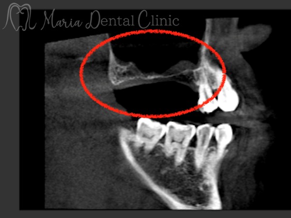 治療中の画像|【症例】サイナスリフトで骨を増やし奥歯の支えを回復したインプラント治療|目白マリア歯科