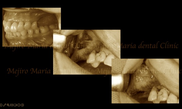 外科画像|【症例】サイナスリフトで骨を増やし奥歯の支えを回復したインプラント治療|目白マリア歯科