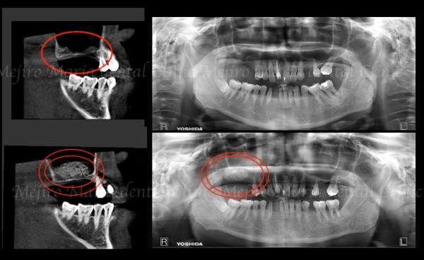治療中の画像2|【症例】サイナスリフトで骨を増やし奥歯の支えを回復したインプラント治療|目白マリア歯科