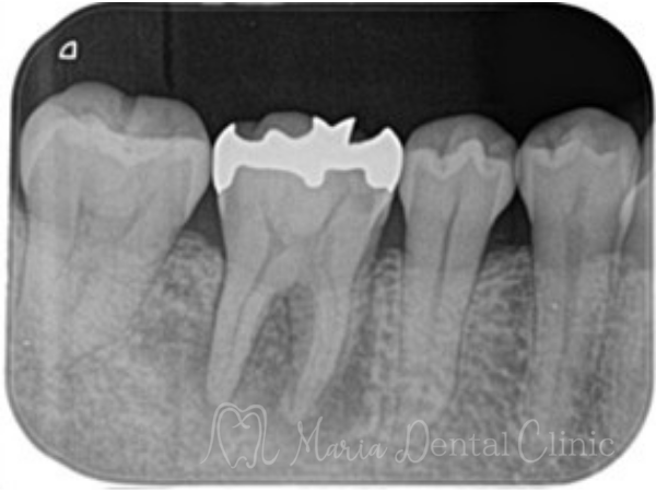 治療前|【症例】被せ物の下で進行した虫歯に対し精密根管治療で歯質を最大限に保存 |目白マリア歯科