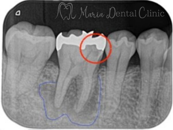 虫歯と根尖性歯周炎の箇所|【症例】被せ物の下で進行した虫歯に対し精密根管治療で歯質を最大限に保存 |目白マリア歯科