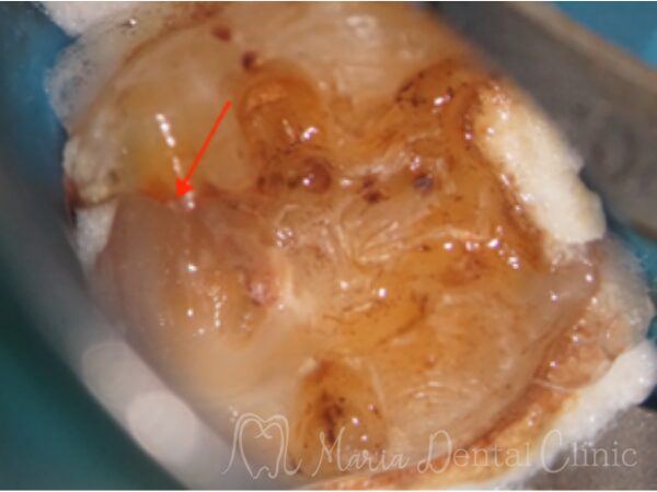 治療中画像|【症例】被せ物の下で進行した虫歯に対し精密根管治療で歯質を最大限に保存 |目白マリア歯科