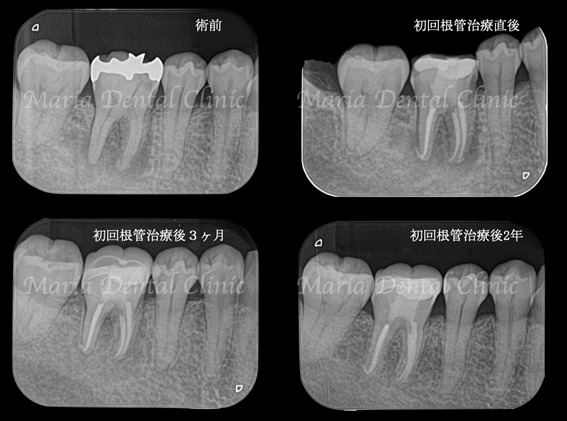 経過画像|【症例】被せ物の下で進行した虫歯に対し精密根管治療で歯質を最大限に保存 |目白マリア歯科