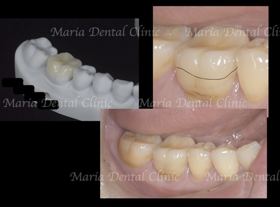 アフター画像|【症例】被せ物の下で進行した虫歯に対し精密根管治療で歯質を最大限に保存 |目白マリア歯科