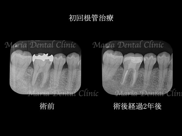 ビフォーアフター｜【症例】被せ物の下で進行した虫歯に対し精密根管治療で歯質を最大限に保存 ｜目白マリア歯科