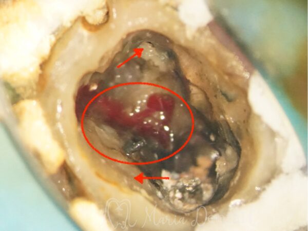 治療詳細1|【症例】他院で抜歯を宣告された歯を再根管治療|目白マリア歯科