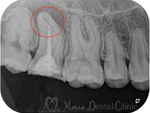 治療前の画像①|【症例】破折ファイルにより難治化した再根管治療:ファイルの破折時の治療方法と考え方|目白マリア歯科