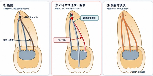 バイパステクニック|【症例】破折ファイルにより難治化した再根管治療:ファイルの破折時の治療方法と考え方|目白マリア歯科