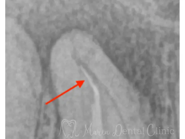 治療前の画像②|【症例】破折ファイルにより難治化した再根管治療:ファイルの破折時の治療方法と考え方|目白マリア歯科