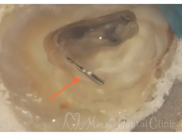 除去された破折ファイル|【症例】破折ファイルにより難治化した再根管治療:ファイルの破折時の治療方法と考え方|目白マリア歯科