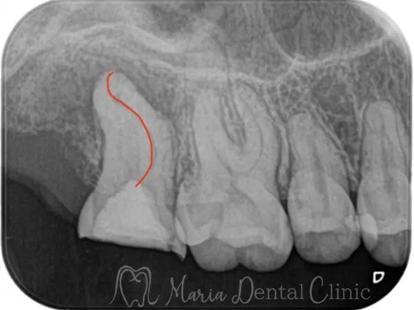 形成したバイパスライン|【症例】破折ファイルにより難治化した再根管治療:ファイルの破折時の治療方法と考え方|目白マリア歯科