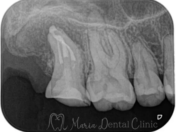 治療直後|【症例】破折ファイルにより難治化した再根管治療:ファイルの破折時の治療方法と考え方|目白マリア歯科